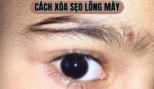 Top 5 cách chữa sẹo lông mày an toàn, nhanh chóng và hiệu quả