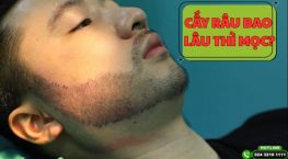 Cấy râu bao lâu thì mọc? Giải đáp chi tiết từ chuyên gia