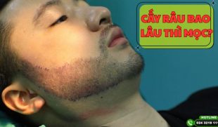 Cấy râu bao lâu thì mọc? Giải đáp chi tiết từ chuyên gia