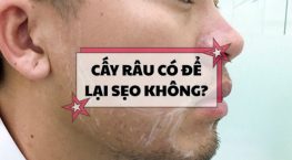 Cấy râu có để lại sẹo không và lưu ý cần biết trước khi thực hiện