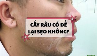 Cấy râu có để lại sẹo không và lưu ý cần biết trước khi thực hiện