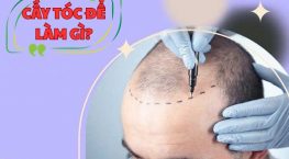 Cấy tóc để làm gì? Giải mã công dụng thực tế của cấy tóc tự thân