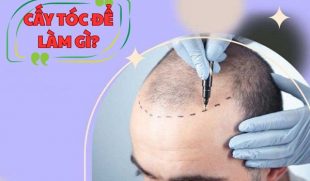 Cấy tóc để làm gì? Giải mã công dụng thực tế của cấy tóc tự thân
