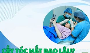 Cấy tóc mất bao lâu? Tìm hiểu quy trình và thời gian cấy tóc thực tế