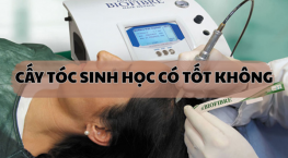 Cấy tóc sinh học có tốt không? 90% người dùng đều không biết điều này!