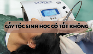 Cấy tóc sinh học có tốt không? 90% người dùng đều không biết điều này!