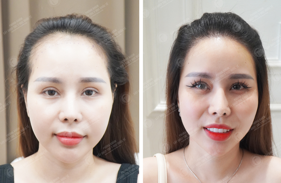  Nguyễn Bích Thùy - Cấy tóc tự thân 1