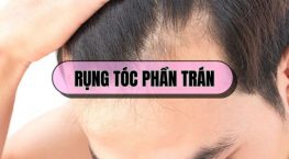 Rụng tóc phần trán: Dấu hiệu hói đầu sớm mà nhiều người chủ quan bỏ qua