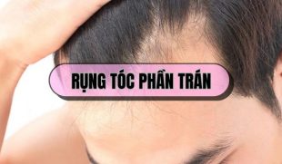 Rụng tóc phần trán: Dấu hiệu hói đầu sớm mà nhiều người chủ quan bỏ qua