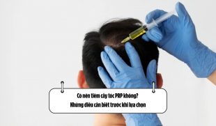 Có nên tiêm cấy tóc PRP không – Những điều cần biết trước khi lựa chọn