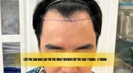 Cấy tóc sau bao lâu thì tóc mọc? Review cấy tóc sau 1 tháng – 3 tháng