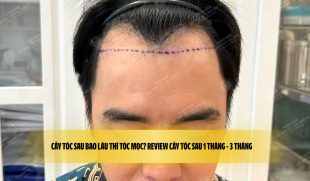 Cấy tóc sau bao lâu thì tóc mọc? Review cấy tóc sau 1 tháng – 3 tháng