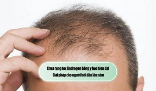 Chữa rụng tóc Androgen bằng y học hiện đại: Giải pháp cho người hói đầu lâu năm