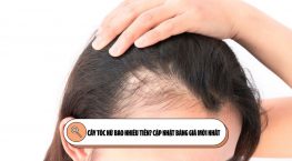 Cấy tóc nữ bao nhiêu tiền? Cập nhật bảng giá mới nhất