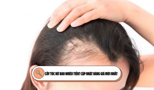 Cấy tóc nữ bao nhiêu tiền? Cập nhật bảng giá mới nhất