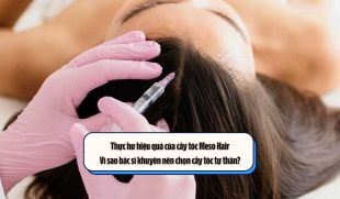 Thực hư hiệu quả của cấy tóc Meso Hair – Vì sao bác sĩ khuyên nên chọn cấy tóc tự thân?