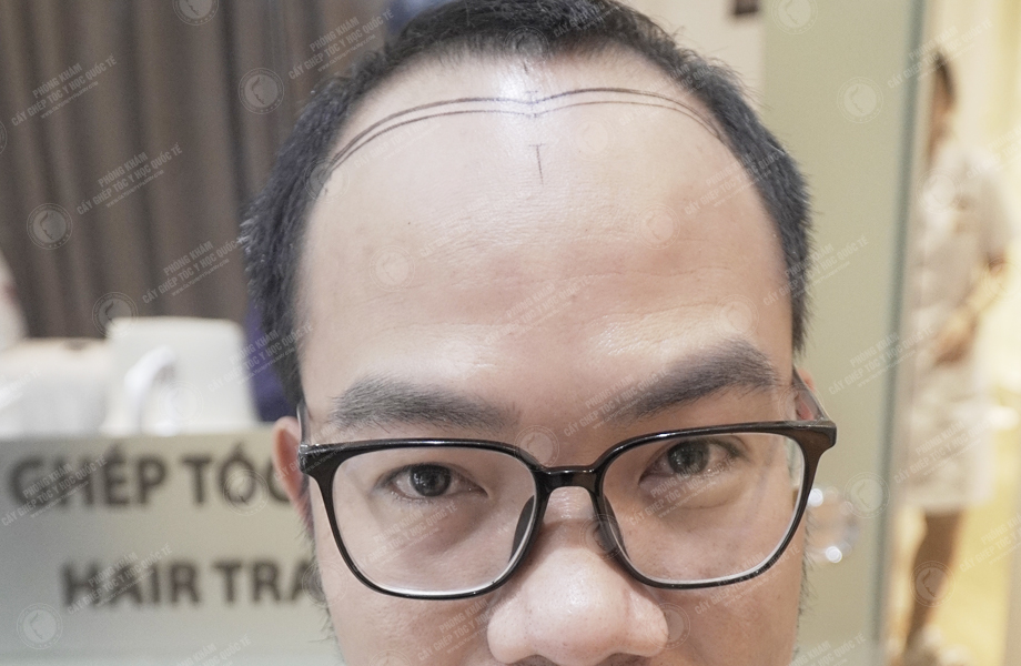 Nguyễn Anh Đức - Cấy tóc đường chữ M 2
