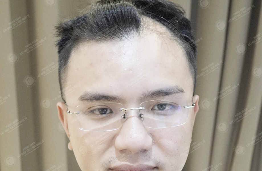 Phạm Công Danh - Cấy tóc đường chữ M 2