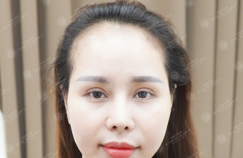 Nguyễn Bích Thùy - Cấy tóc tự thân 2