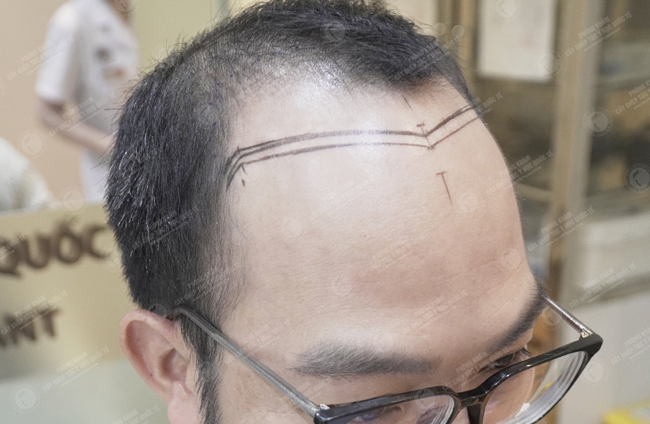 Nguyễn Anh Đức - Cấy tóc đường chữ M 3