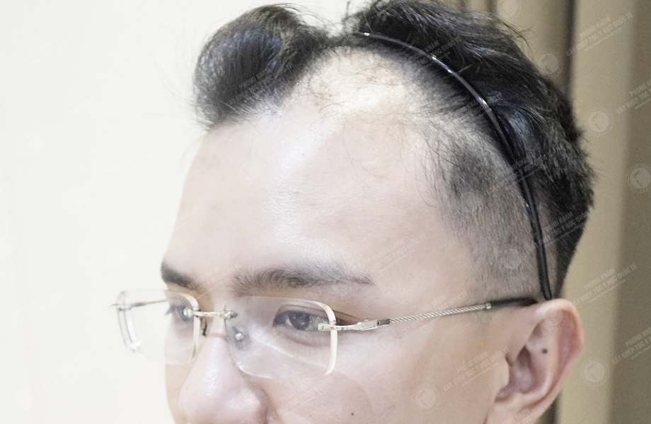 Phạm Công Danh - Cấy tóc đường chữ M 3