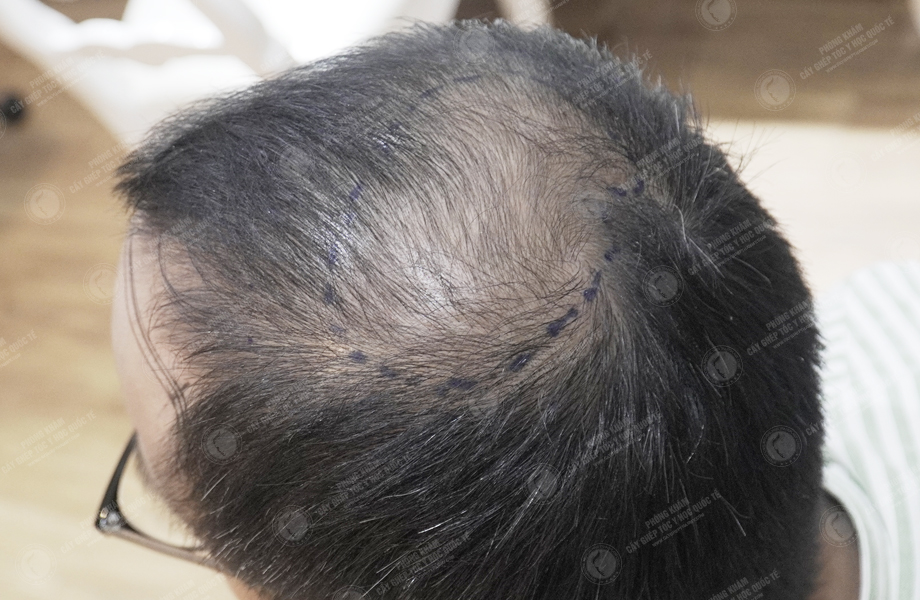 Nguyễn Anh Đức - Cấy tóc đường chữ M 4