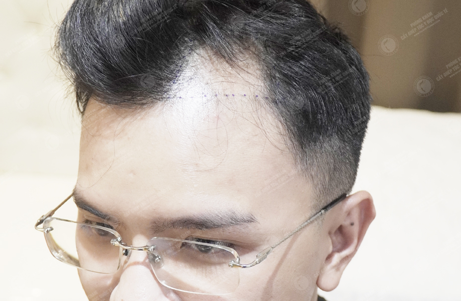 Phạm Công Danh - Cấy tóc đường chữ M 4