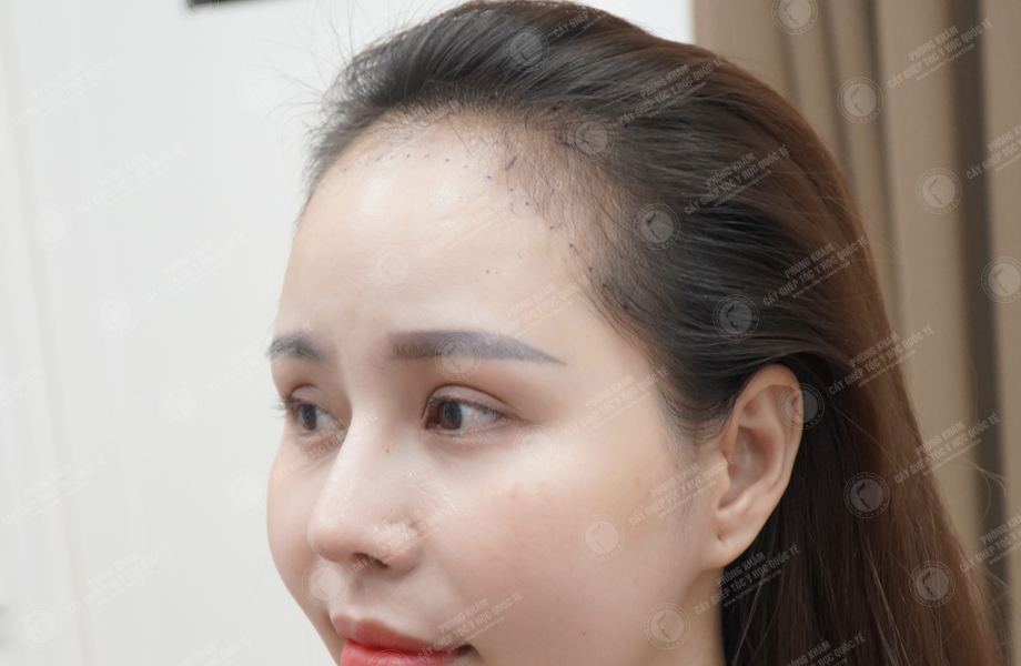 Nguyễn Bích Thùy - Cấy tóc tự thân 4