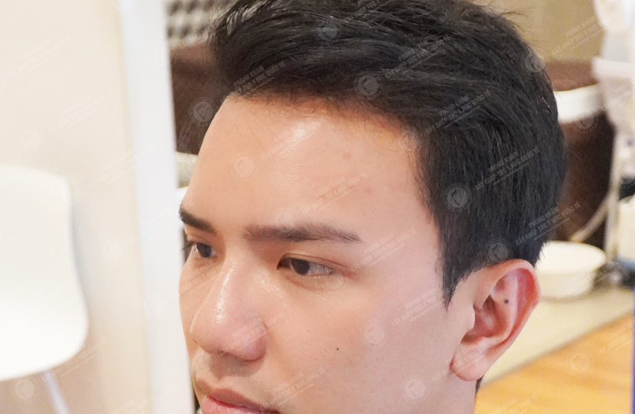 Phạm Công Danh - Cấy tóc đường chữ M 5
