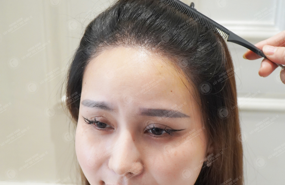 Nguyễn Bích Thùy - Cấy tóc tự thân 5