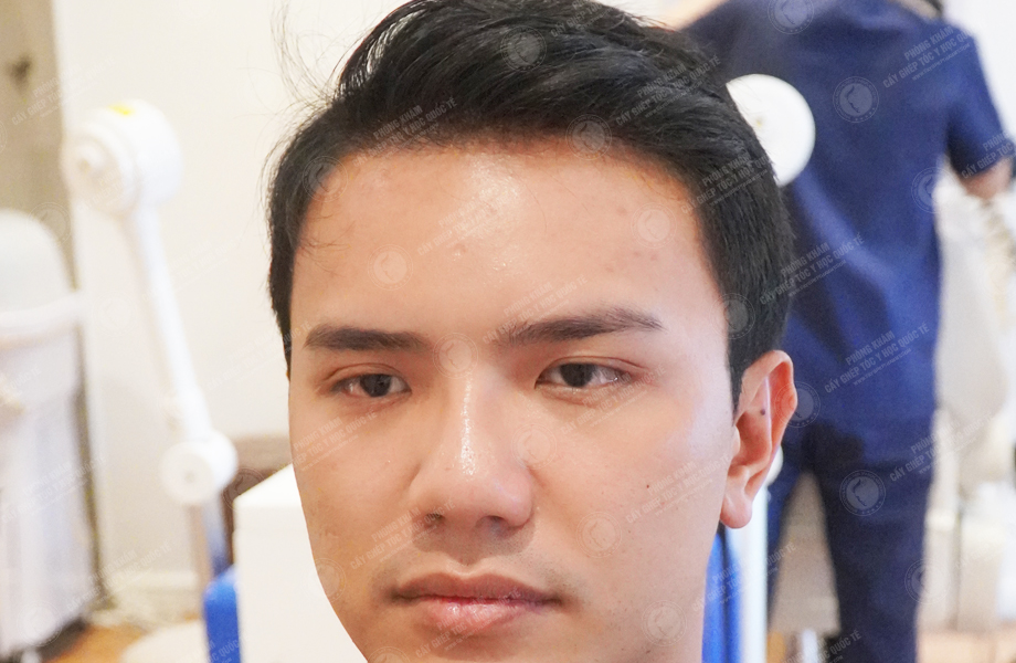 Phạm Công Danh - Cấy tóc đường chữ M 6