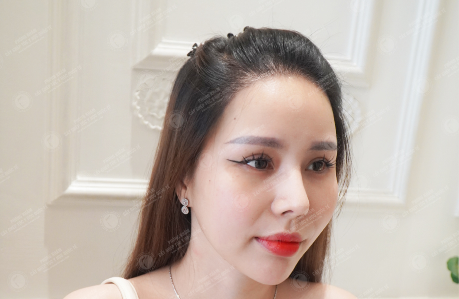 Nguyễn Bích Thùy - Cấy tóc tự thân 6