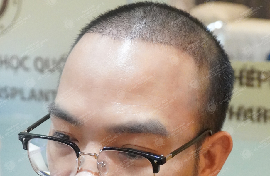 Nguyễn Anh Đức - Cấy tóc đường chữ M 7