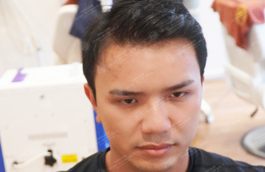 Phạm Công Danh - Cấy tóc đường chữ M 7