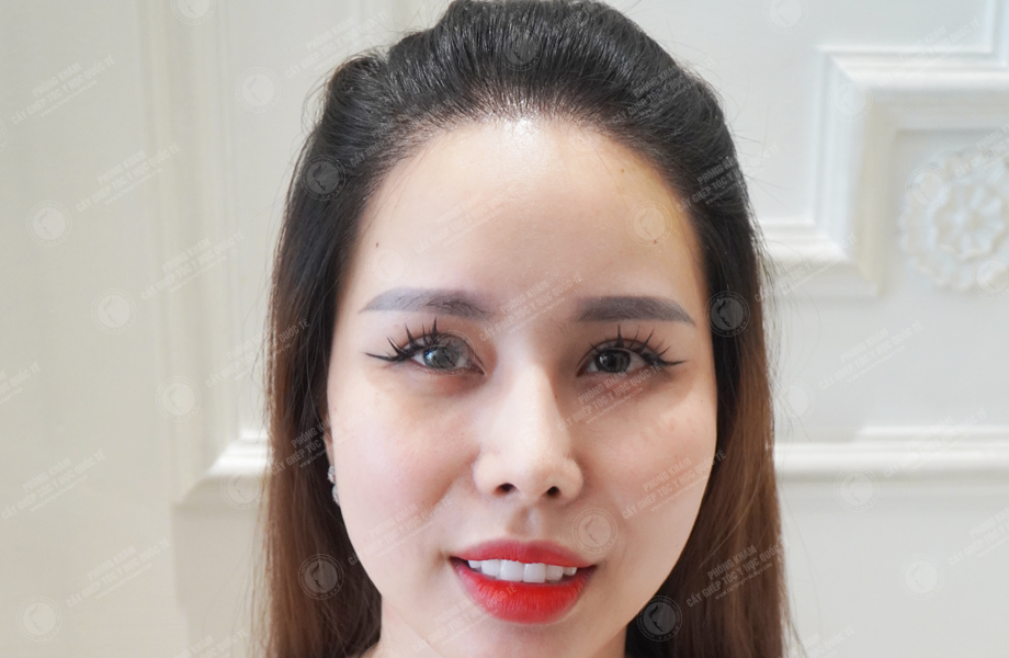 Nguyễn Bích Thùy - Cấy tóc tự thân 7