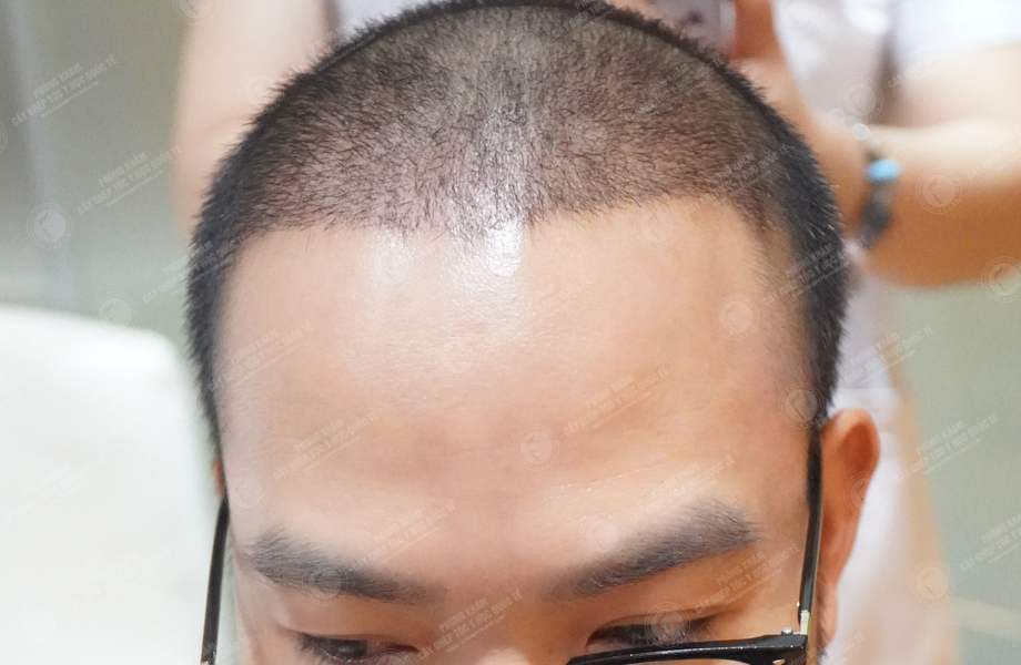 Nguyễn Anh Đức - Cấy tóc đường chữ M 8