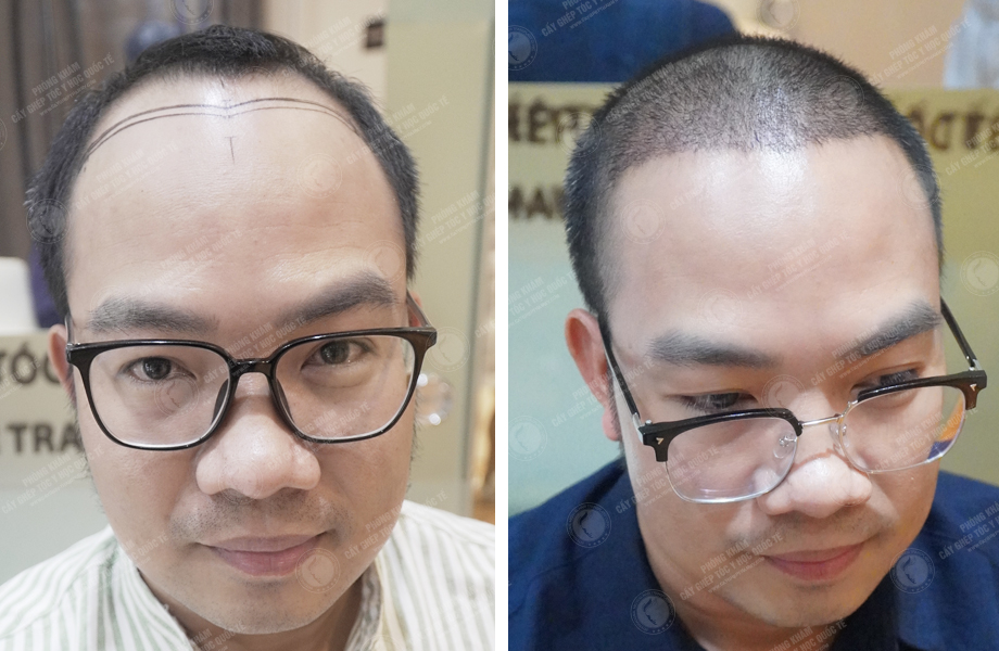  Nguyễn Anh Đức - Cấy tóc đường chữ M 1