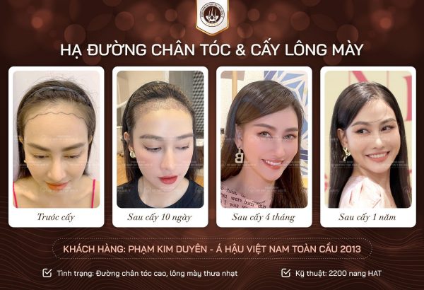 Địa chỉ cấy tóc uy tín tại TPHCM được nhiều người nổi tiếng và KOL tin chọn