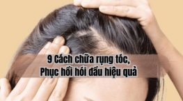 9 Cách chữa tóc rụng, phục hồi hói đầu hiệu quả nhất!
