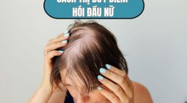 Cách trị hói đầu ở nữ dứt điểm giúp tóc mọc dày đẹp chỉ sau 1 lần thực hiện