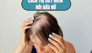 Cách trị hói đầu ở nữ dứt điểm giúp tóc mọc dày đẹp chỉ sau 1 lần thực hiện