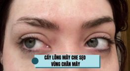 Cấy lông mày che sẹo vùng chân mày: Cứu cánh cho những vết sẹo từng “phá nét” khuôn mặt