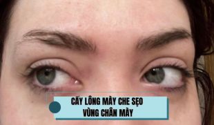 Cấy lông mày che sẹo vùng chân mày: Cứu cánh cho những vết sẹo từng “phá nét” khuôn mặt