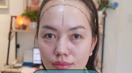 Cấy tóc trán cao – Giải pháp lấy lại đường chân tóc tự nhiên và sự tự tin