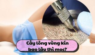 Cấy lông vùng kín bao lâu thì mọc? Chia sẻ thực tế và kinh nghiệm từ chuyên gia