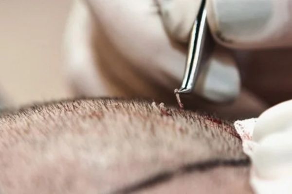 Cấy tóc FUE, HAT và DHI: Hướng dẫn lựa chọn phương pháp phù hợp Cấy tóc FUE, HAT và DHI: Hướng dẫn lựa chọn phương pháp phù hợp