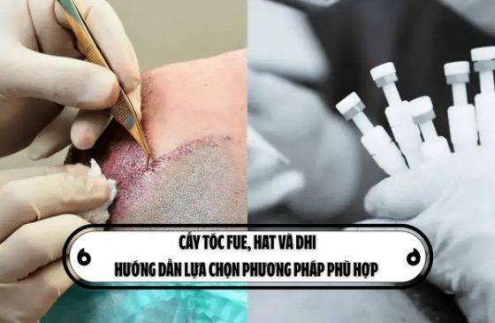 Cấy tóc FUE, HAT và DHI: Hướng dẫn lựa chọn phương pháp phù hợp 