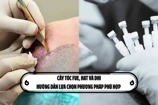 Cấy tóc FUE, HAT và DHI: Hướng dẫn lựa chọn phương pháp phù hợp