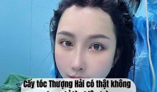 Cấy tóc Thượng Hải có thật không hay chỉ là chiêu trò? Toàn cảnh sự thật khách hàng cần biết trước khi xuống tiền