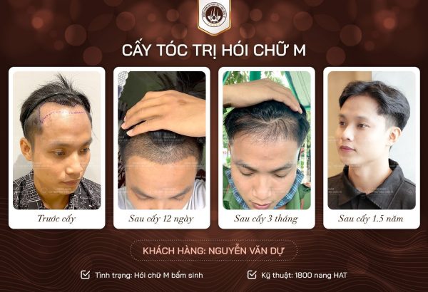 Cấy tóc trị hói chữ M bằng phương pháp HAT Cấy tóc trị hói chữ M bằng phương pháp HAT
